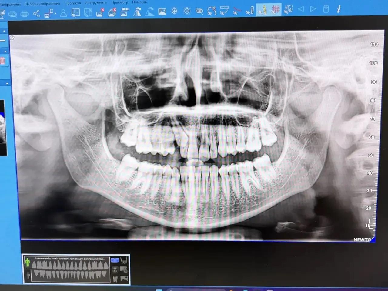 Установка брекетов взрослым